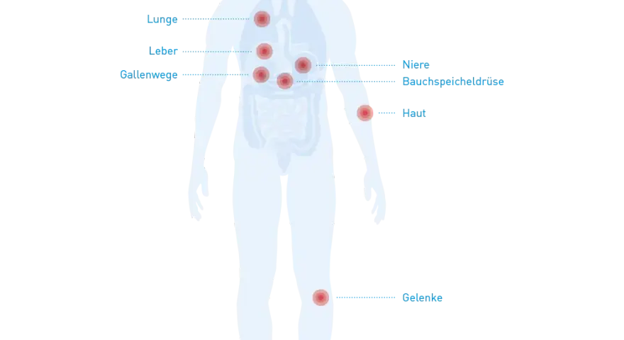 Morbus Crohn: Diese Medikamente unbedingt meiden (Ärzte-Tipps)