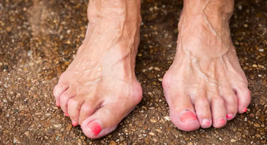 Füße mit Hallux Valgus, eine mögliche Hallux Ursache ist die genetische Veranlagung. Die Zehen sind deformiert.