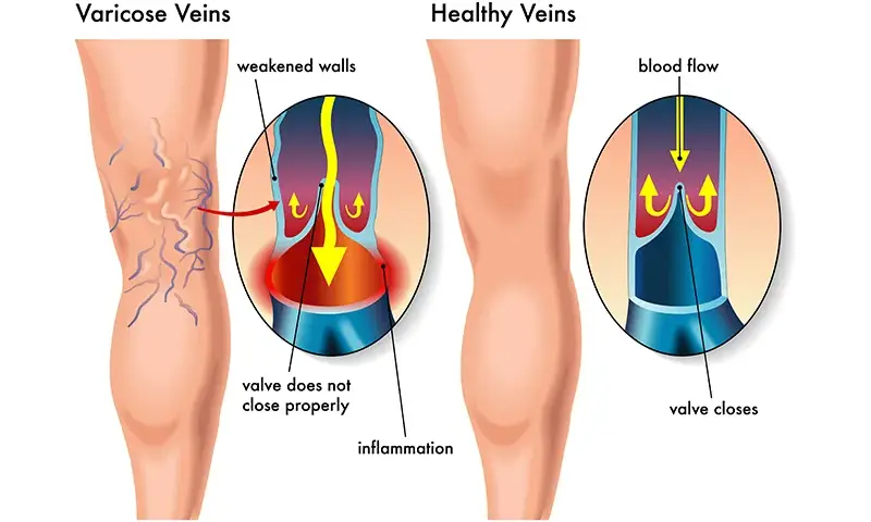 Bein Thrombose Symptome: Warnsignale erkennen & richtig handeln