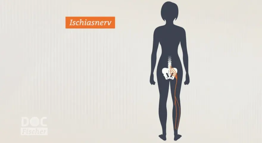 Illustration zeigt den Ischiasnerv, der vom Rückenmark bis ins Bein verläuft. Reizung kann zu Ischias Schmerz führen.