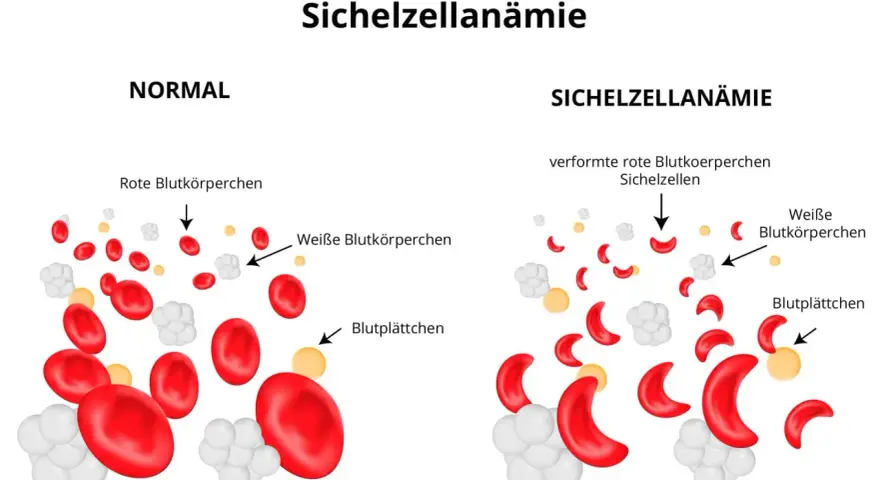 Sichelzellanämie Diagnose: Labor, Tests & Gentest erklärt
