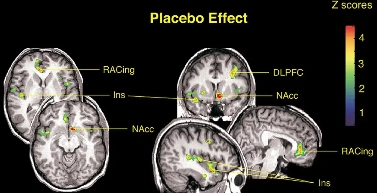 Placebo-Effekt Gehirn Aktivität