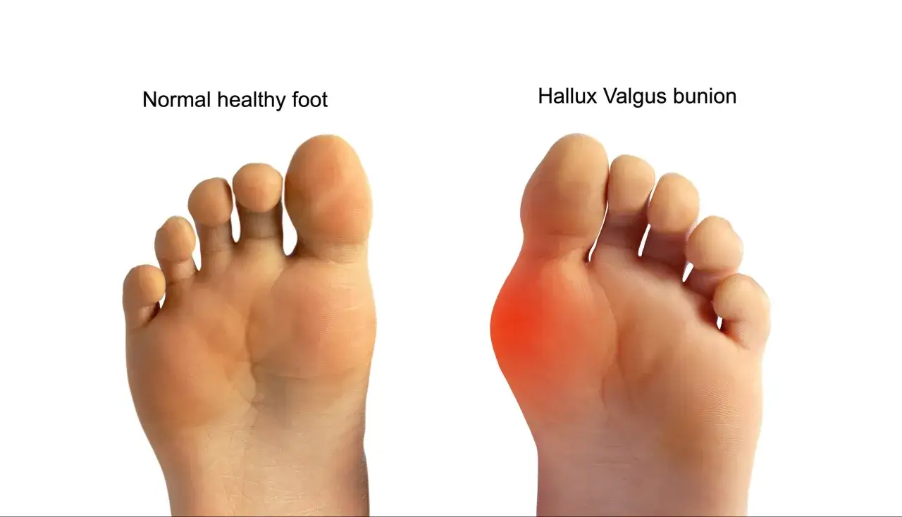 Vergleich von gesunden Füßen und einem Hallux Valgus Ballen, der eine häufige Ursache für Fußschmerzen ist.