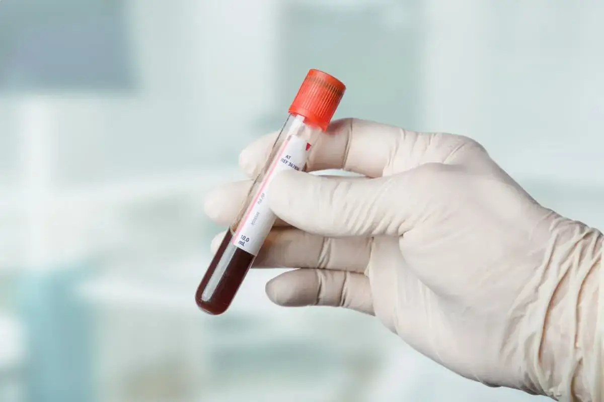Labordiagnostik Sichelzellan&auml;mie Blutprobe