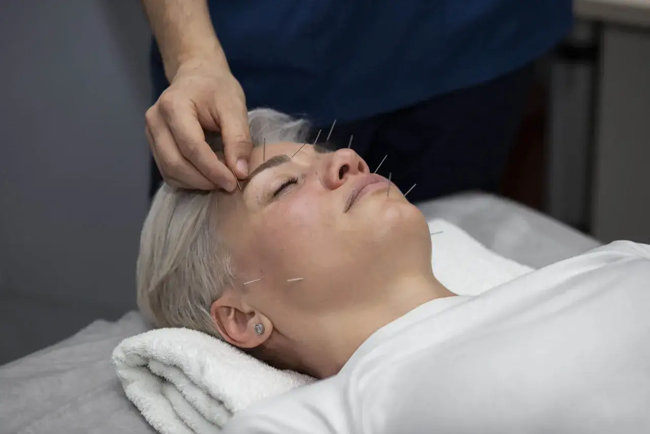 Eine Frau erhält Akupunktur im Gesicht. Ein Physiotherapeut setzt die Nadeln. Darf ein Physiotherapeut Akupunktur machen? Ja, mit entsprechender Weiterbildung.