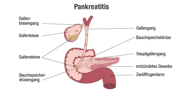 Frühe Symptome chronische Pankreatitis