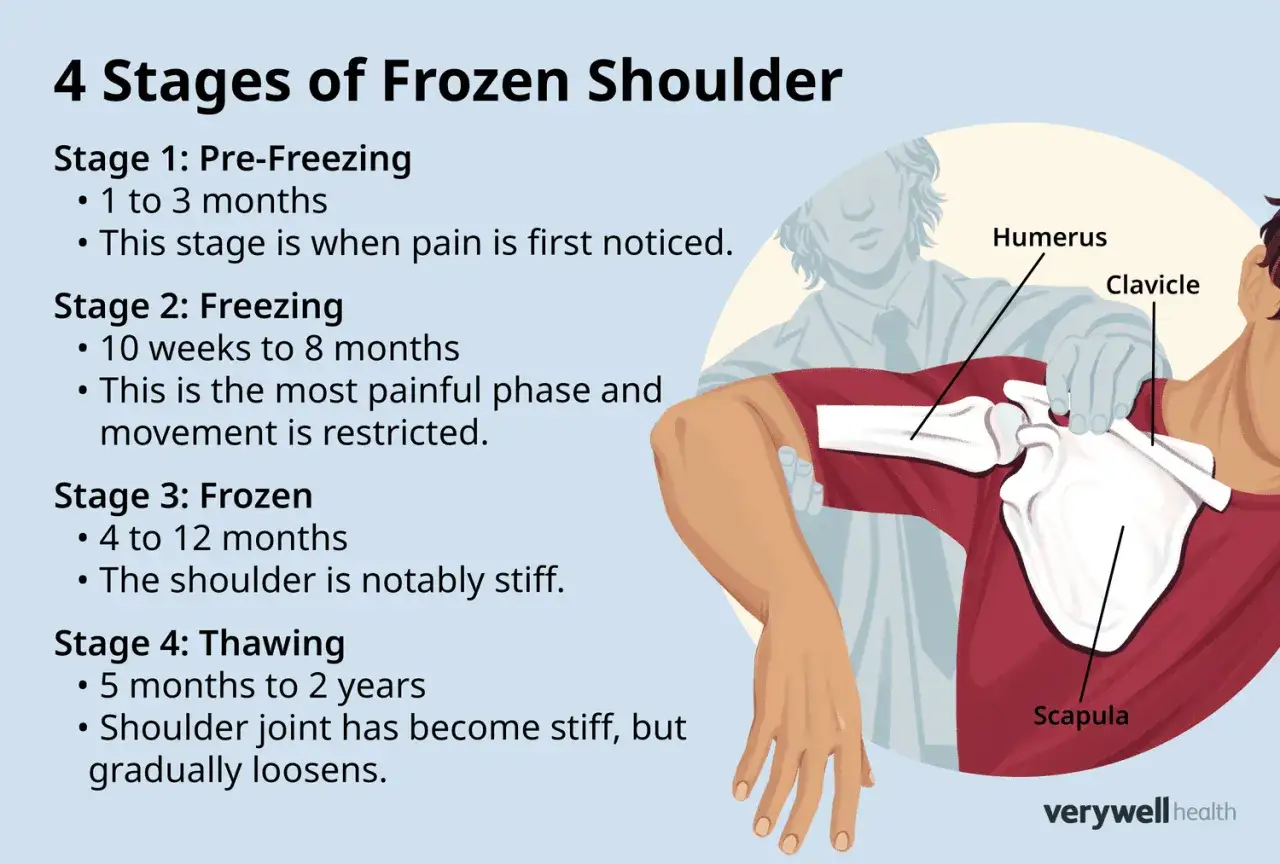 Grafik zeigt die 4 frozen shoulder phasen: Vor-Einfrieren, Einfrieren, Gefroren und Auftauen. Anatomie des Schultergelenks.