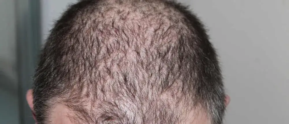 Haarausfall Ursachen Nährstoffmangel