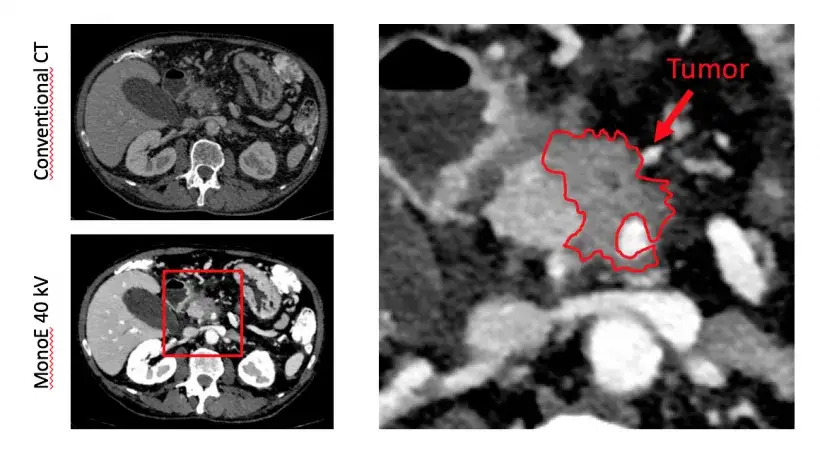 Bauchspeicheldr&uuml;se Ultraschall CT MRT