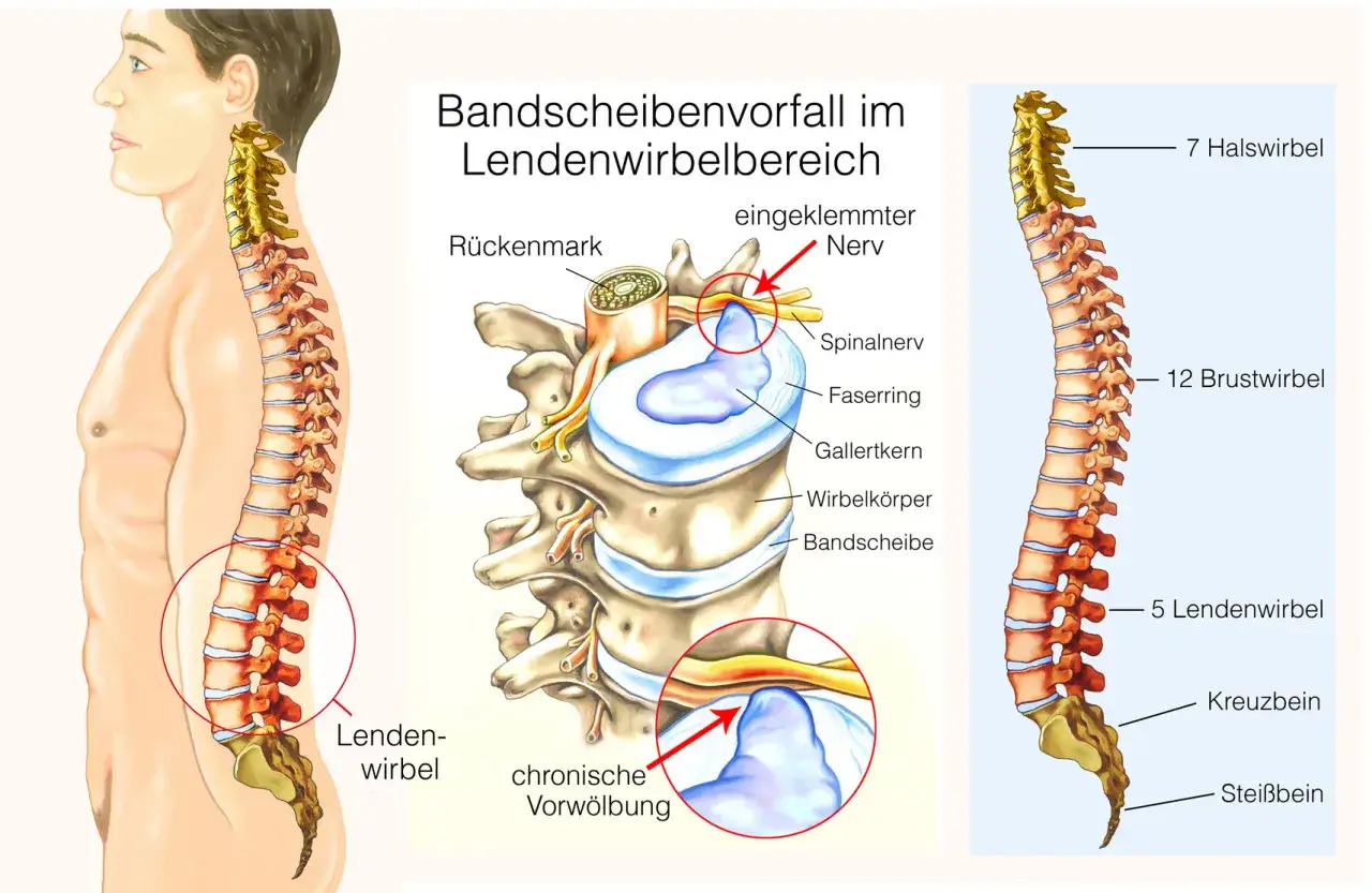 Bandscheibenvorfall Nervenkompression