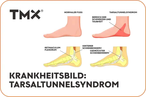 Vergleich Fuß: Normal vs. Tarsaltunnelsyndrom. Ursachen: Nervenkompression im Tarsaltunnel.