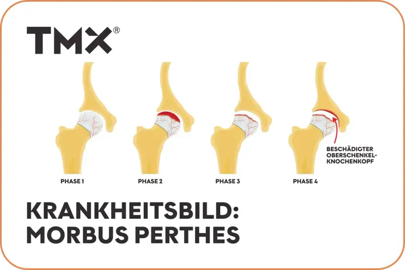 Illustration von 4 Phasen des Morbus Perthes am Hüftgelenk.