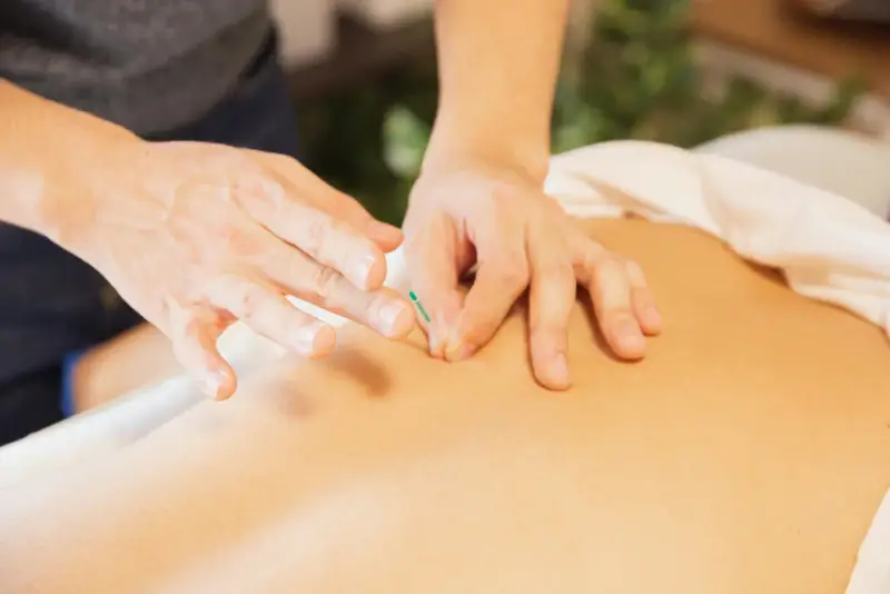 Ein Physiotherapeut setzt eine Akupunkturnadel. Dies ist eine Behandlungsmethode, die auch von Physiotherapeuten angewendet werden darf.