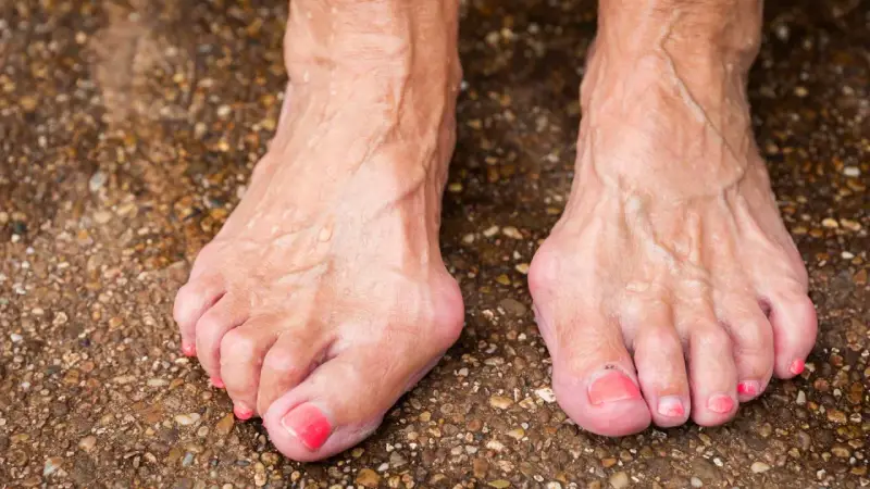 Füße mit Hallux Valgus, eine mögliche Hallux Ursache ist die genetische Veranlagung. Die Zehen sind deformiert.