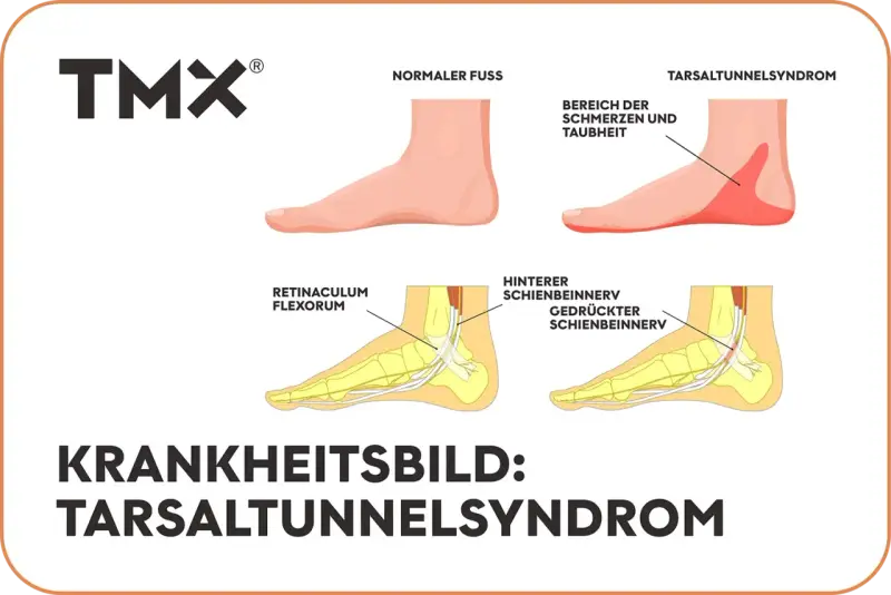 Vergleich Fuß: Normal vs. Tarsaltunnelsyndrom. Ursachen: Nervenkompression im Tarsaltunnel.